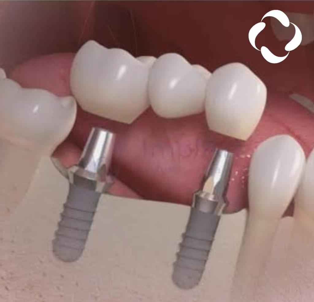 Invisalign - Removível